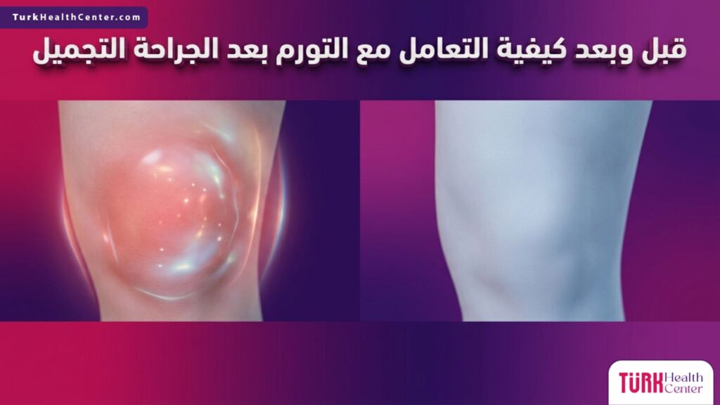 مقارنة تظهر حالة الأنسجة قبل وبعد تطبيق إرشادات كيفية التعامل مع التورم بعد الجراحة التجميل.