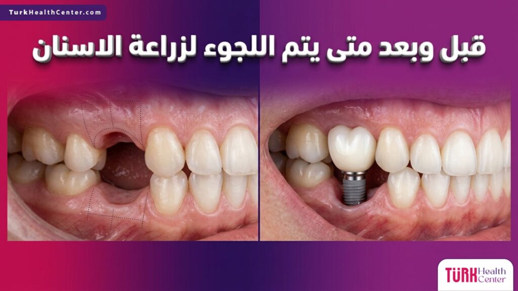 صورة قبل وبعد توضح متى يتم اللجوء لزراعة الاسنان وتأثيرها على استعادة الأسنان المفقودة.