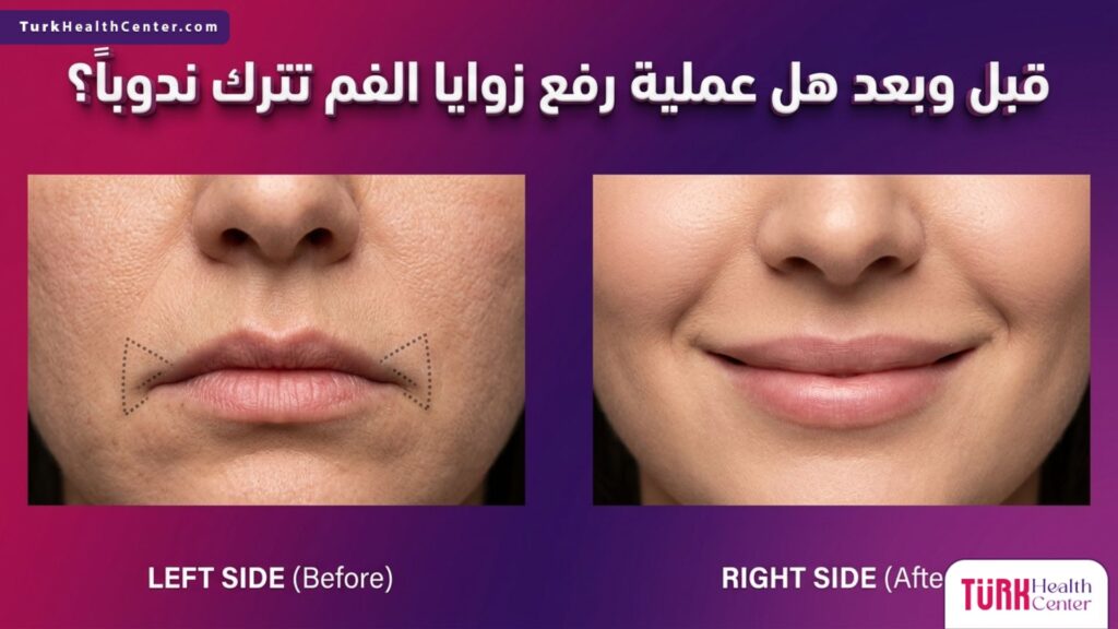 مقارنة قبل وبعد توضح جودة التئام الجروح وتجيب عن تساؤل هل عملية رفع زوايا الفم تترك ندوباً؟