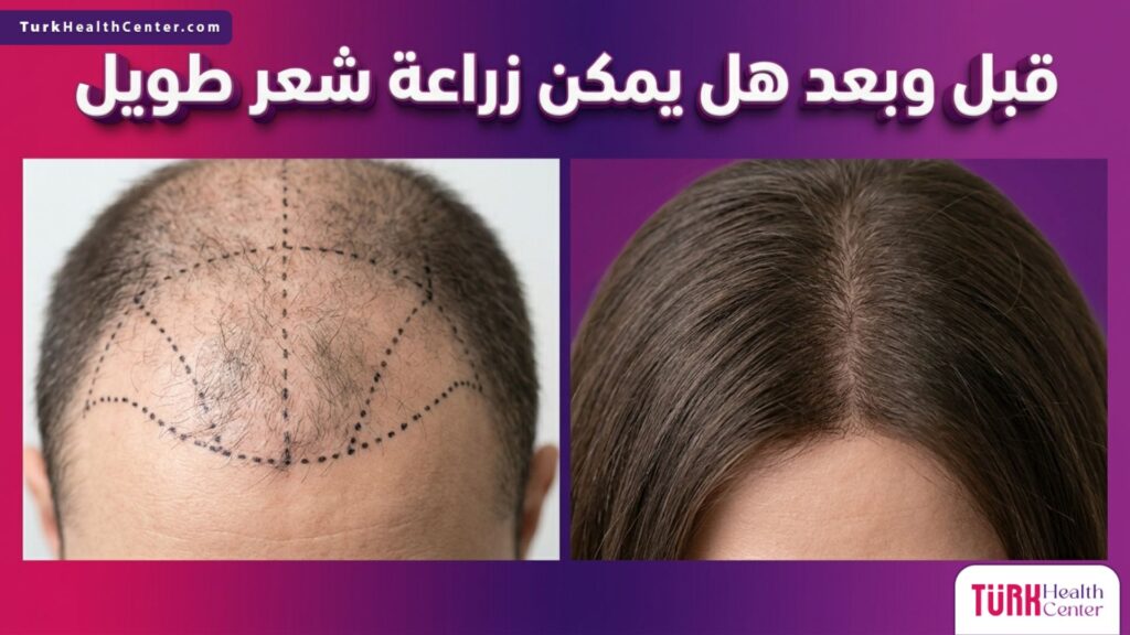 مقارنة قبل وبعد توضح هل يمكن زراعة شعر طويل مع تحديد الخطوط الطبية لزراعة البصيلات الطويلة والنتيجة النهائية