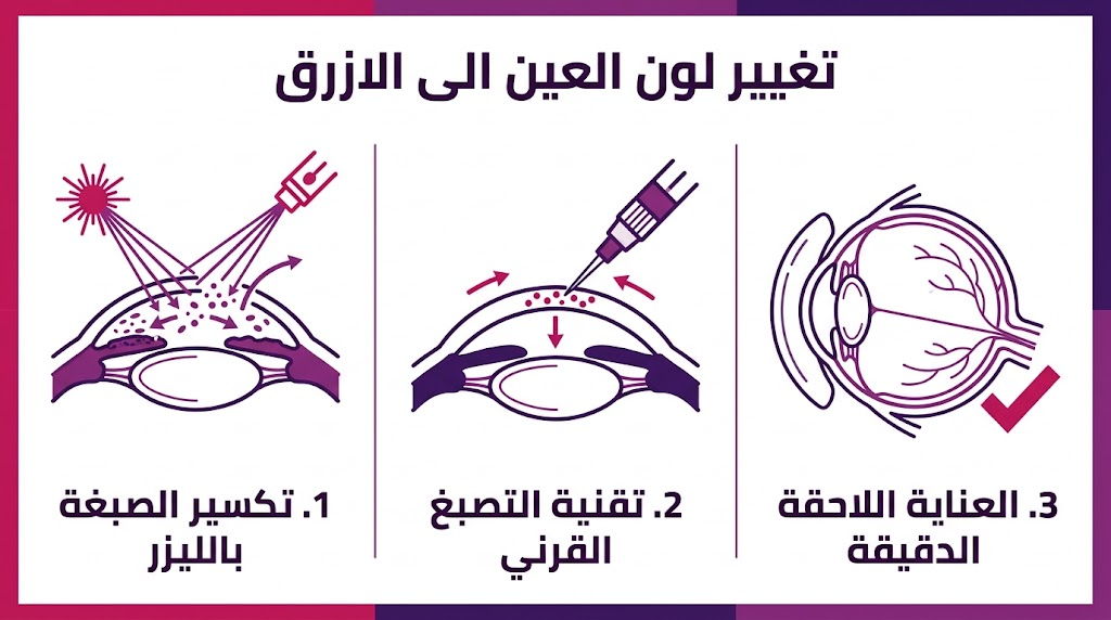 ملصق إنفوجرافيك ناقل طبي يوضح ثلاث خطوات رئيسية لعملية تغيير لون العين الى الازرق باستخدام الليزر والتصبغ القرني والعناية اللاحقة، مع عناوين عربية واضحة لكل قسم.