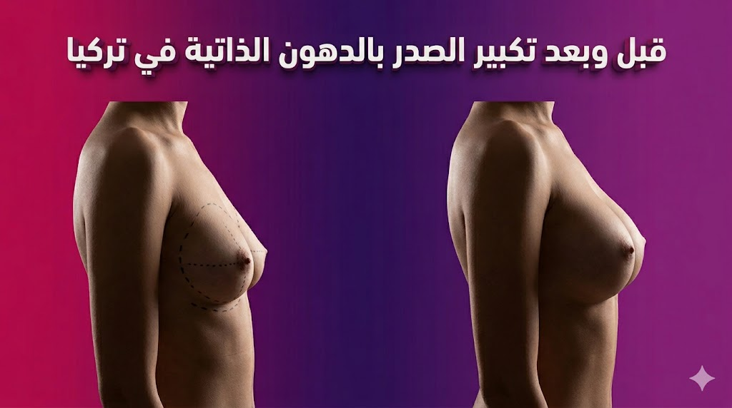 مقارنة جانبية أنيقة توضح نتائج قبل وبعد تكبير الصدر بالدهون الذاتية في تركيا مع مخطط طبي دقيق.