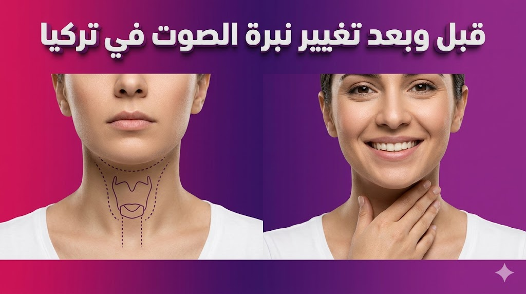  مقارنة قبل وبعد توضح علامات التخطيط الجراحي والنتائج النهائية الناجحة لعملية تغيير نبرة الصوت في تركيا.