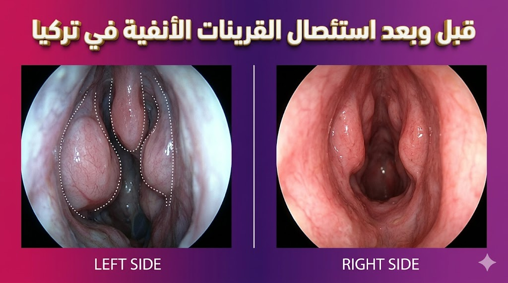 مقارنة قبل وبعد توضح تحسن مجرى التنفس بعد إجراء استئصال القرينات الأنفية في تركيا