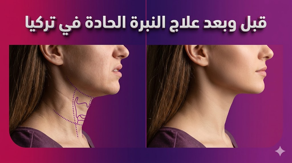 مقارنة قبل وبعد توضح نتائج علاج النبرة الحادة في تركيا على منطقة الحنجرة والأوتار الصوتية.