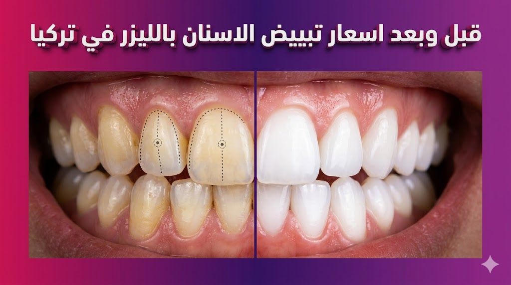 صورة قبل وبعد توضح نتائج اسعار تبييض الاسنان بالليزر في تركيا مع علامات طبية دقيقة.
