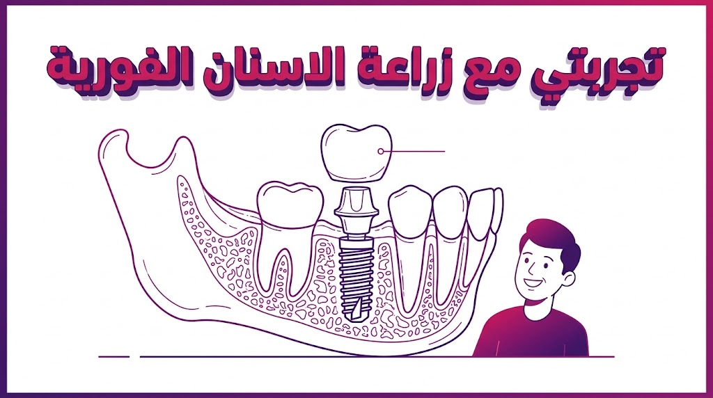مخطط تشريحي يوضح كيفية تركيب الغرسات أثناء تجربتي مع زراعة الاسنان الفورية.