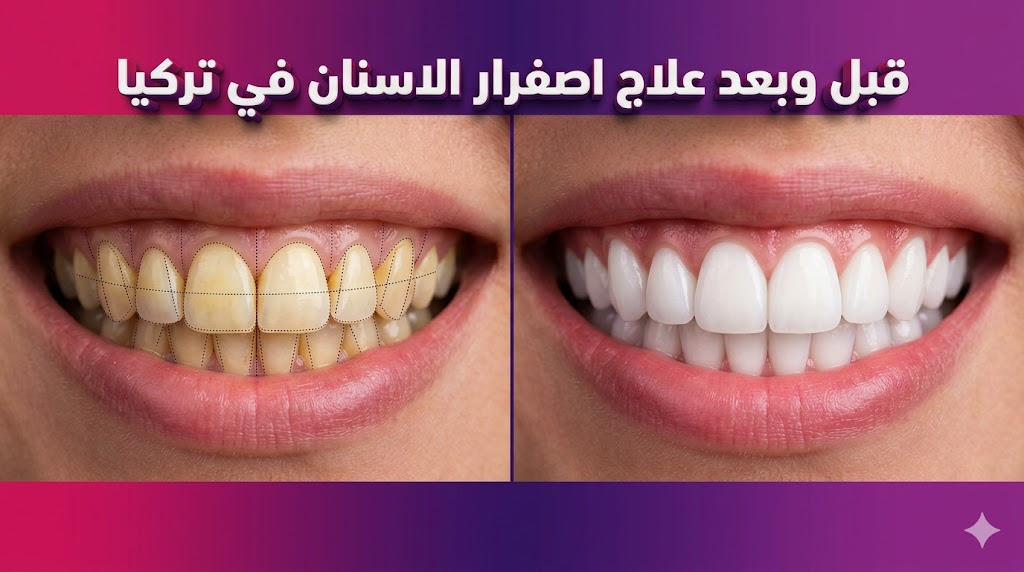  مقارنة قبل وبعد تظهر نتائج علاج اصفرار الاسنان في تركيا والتحول المذهل لابتسامة بيضاء ناصعة.