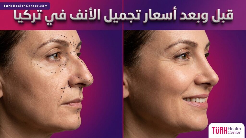 صورة مقارنة قبل وبعد تظهر التغيير الجذري والناجح في شكل الأنف وعلاقتها بجدوى أسعار تجميل الأنف في تركيا.