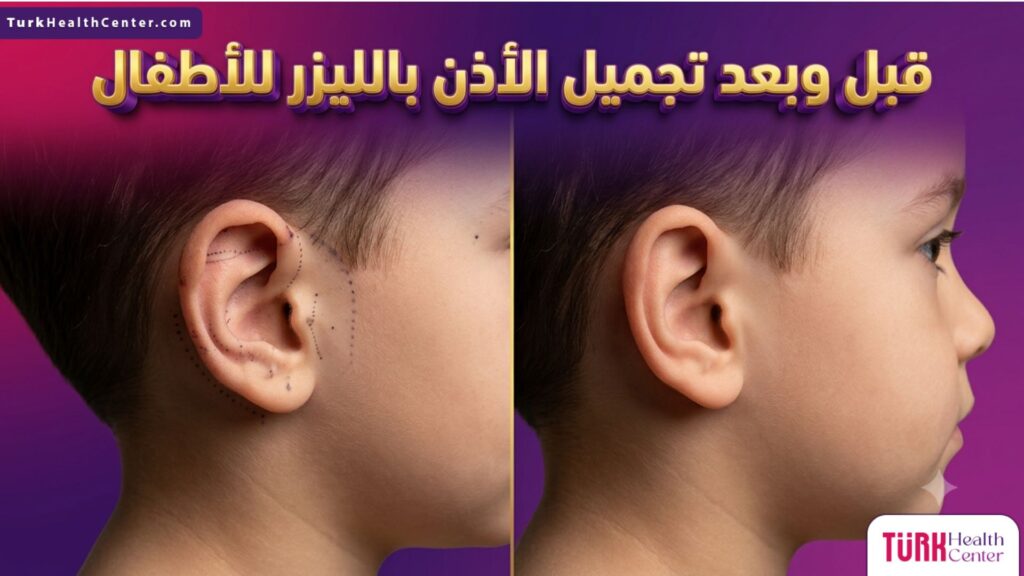صورة مقسمة قبل وبعد تظهر نتائج تجميل الأذن بالليزر للأطفال بدقة عالية.