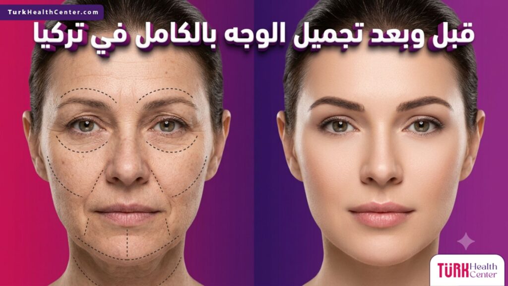 مقارنة قبل وبعد تجميل الوجه بالكامل في تركيا توضح التخطيط الجراحي والنتيجة النهائية المشرقة.