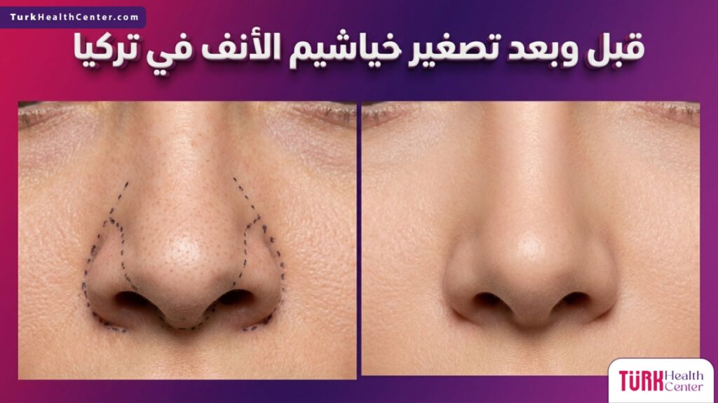 صورة مقسمة قبل وبعد عملية تصغير خياشيم الأنف في تركيا تظهر التحديدات الجراحية والنتيجة النهائية المتناسقة.