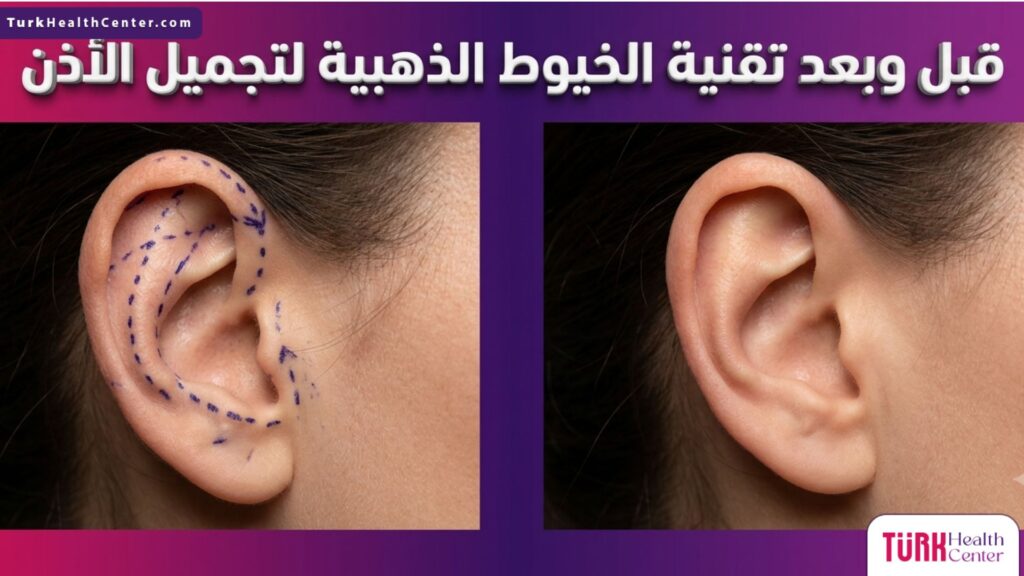 مقارنة قبل وبعد استخدام تقنية الخيوط الذهبية لتجميل الاذن لتعديل البروز