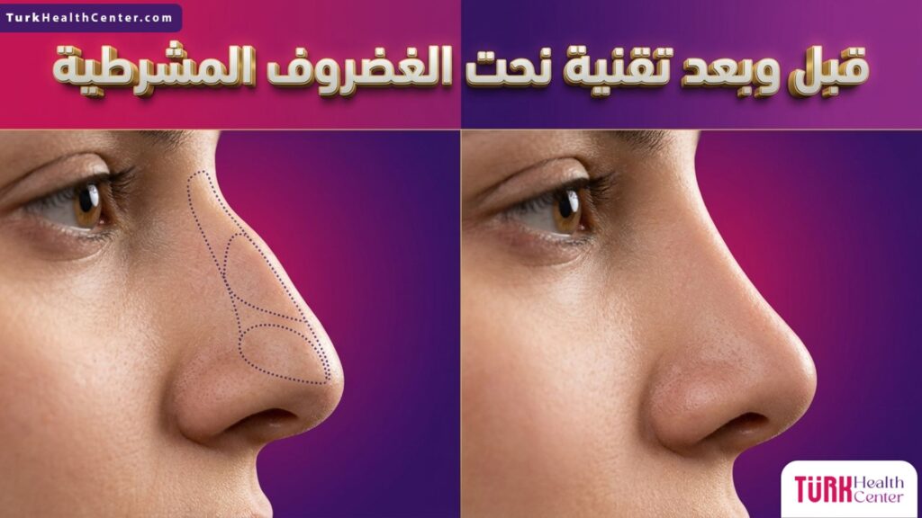 مقارنة بصرية لنتيجة قبل وبعد إجراء تقنية نحت الغضروف المشرطية مع علامات جراحية دقيقة توضح مناطق النحت.