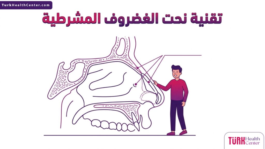 مخطط طبي تشريحي يوضح التركيب الداخلي لغضاريف الأنف ونقاط الاستهداف في تقنية نحت الغضروف المشرطية.