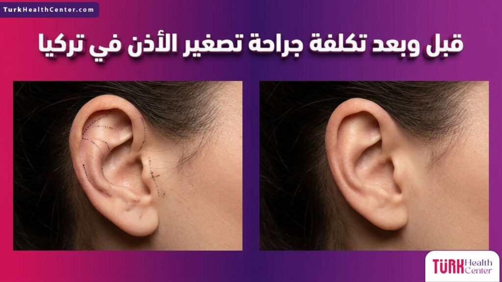 مقارنة قبل وبعد تظهر نتائج وتكلفة جراحة تصغير الأذن في تركيا بشكل احترافي