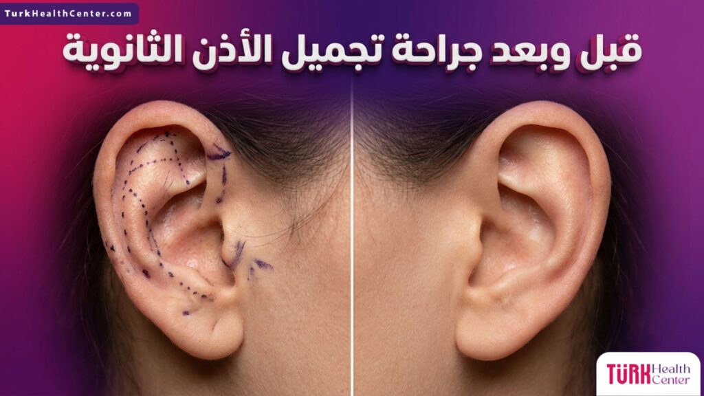 صورة مقسمة تظهر الأذن قبل وبعد جراحة تجميل الأذن الثانوية مع العلامات الجراحية التخطيطية