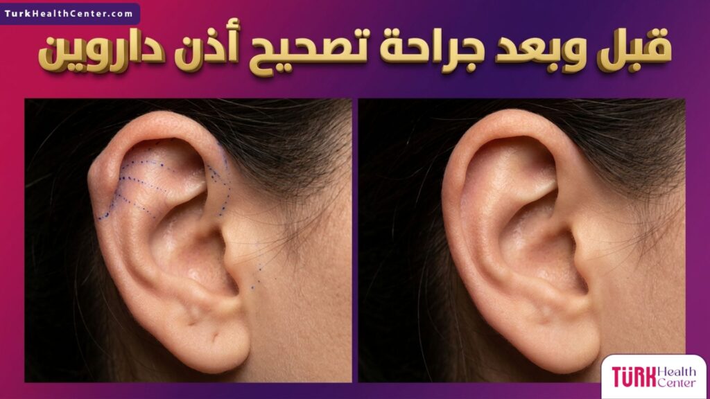 صورة مقسمة تظهر الأذن قبل وبعد جراحة تصحيح أذن داروين مع توضيح الخطوط الطبية للغضروف