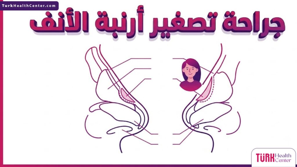 رسم توضيحي لتشريح غضاريف الأنف وكيفية إجراء جراحة تصغير أرنبة الأنف.