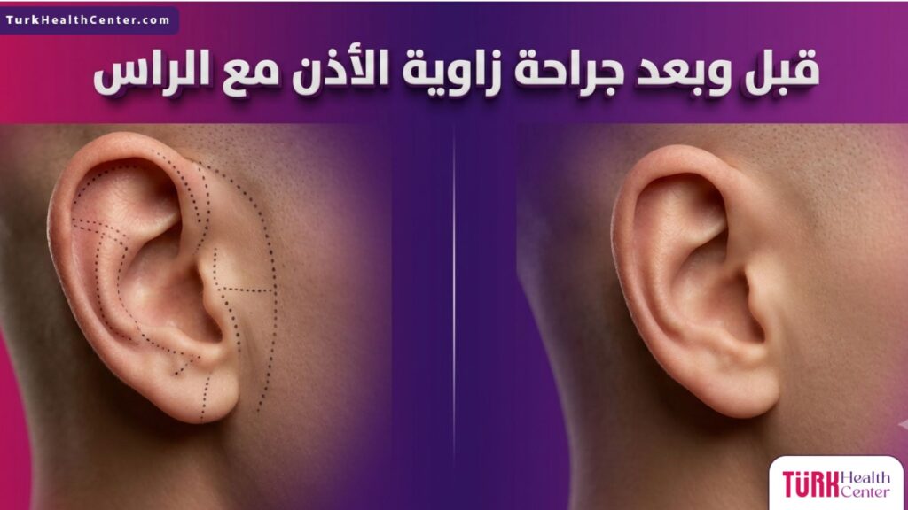 صورة مقسمة تظهر حالة الأذن البارزة قبل وبعد جراحة زاوية الاذن مع الراس مع خطوط الجراحة التجميلية الدقيقة.