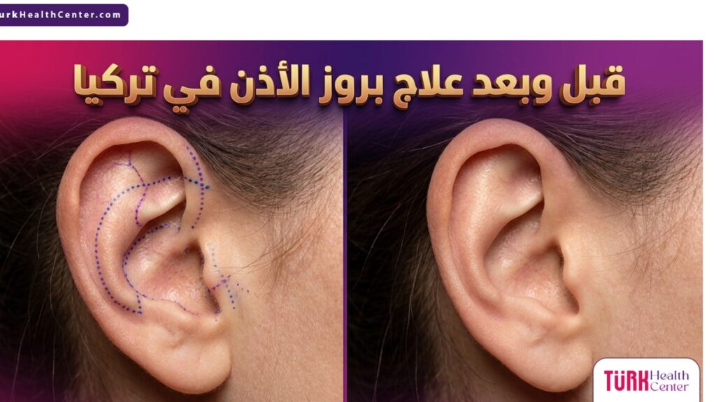 مقارنة قبل وبعد علاج بروز الأذن في تركيا مع إظهار النتائج الطبيعية والمثالية للعملية.