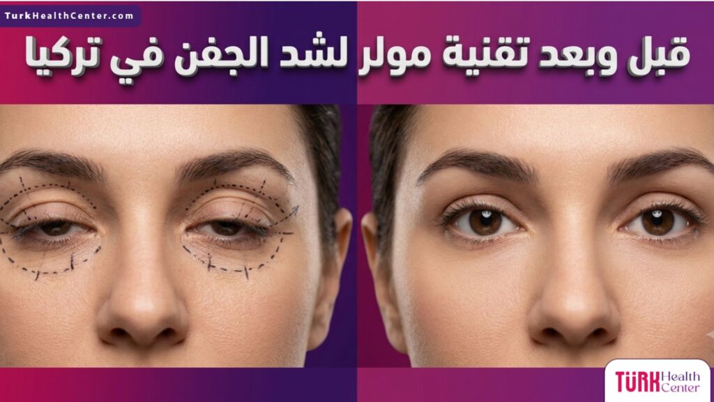 مقارنة قبل وبعد تقنية مولر لشد الجفن في تركيا تظهر تصحيح ارتخاء الجفن العلوي بنجاح وتماثل العينين.