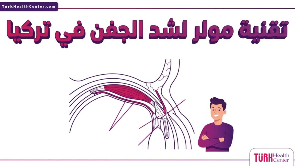 مخطط تشريحي طبي يوضح آلية عمل تقنية مولر لشد الجفن في تركيا عبر تقصير عضلة مولر الداخلية.
