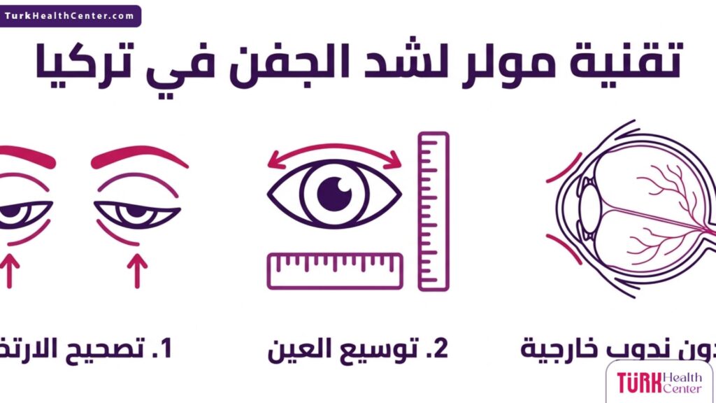 إنفوجرافيك طبي باللغة العربية يستعرض الفوائد الثلاث لـ تقنية مولر لشد الجفن في تركيا.