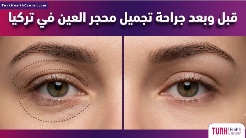 مقارنة قبل وبعد لنتائج جراحة تجميل محجر العين في تركيا، تظهر التخطيط الطبي الدقيق للعين والنتيجة النهائية المتناسقة.
