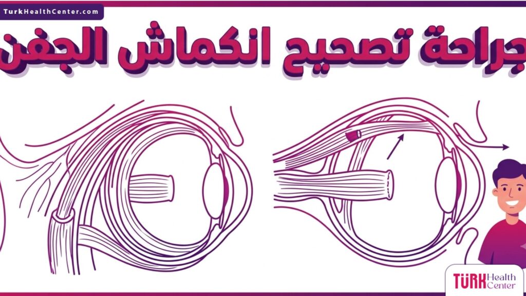 مخطط تشريحي دقيق لعضلات العين يوضح آلية عمل جراحة تصحيح انكماش الجفن.