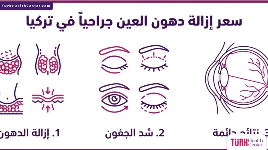 إنفوجرافيك طبي يوضح مراحل العملية والنتائج المتوقعة عند السؤال عن سعر إزالة دهون العين جراحياً في تركيا