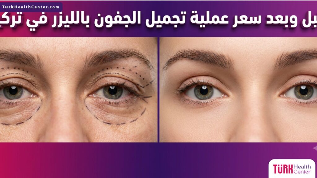 مقارنة قبل وبعد تخطيط جراحي لعينين مع توضيح سعر عملية تجميل الجفون بالليزر في تركيا.