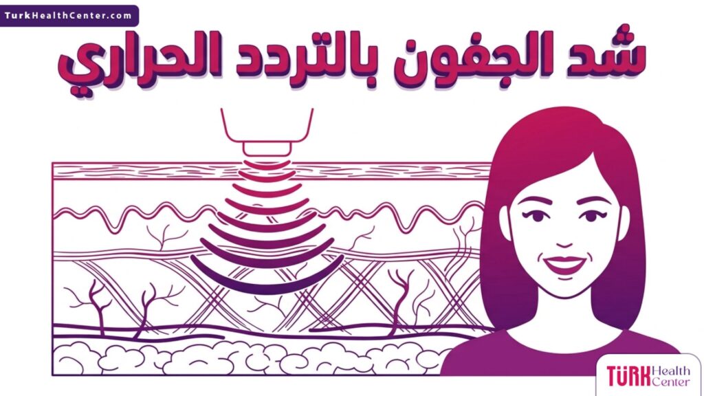 رسم تشريحي دقيق يوضح كيفية عمل شد الجفون بالتردد الحراري داخل طبقات الجلد.