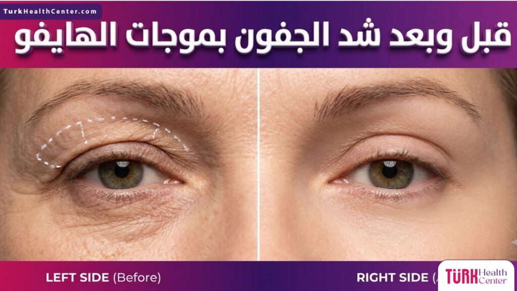 صورة فوتوغرافية دقيقة توضح نتائج قبل وبعد شد الجفون بموجات الهايفو.