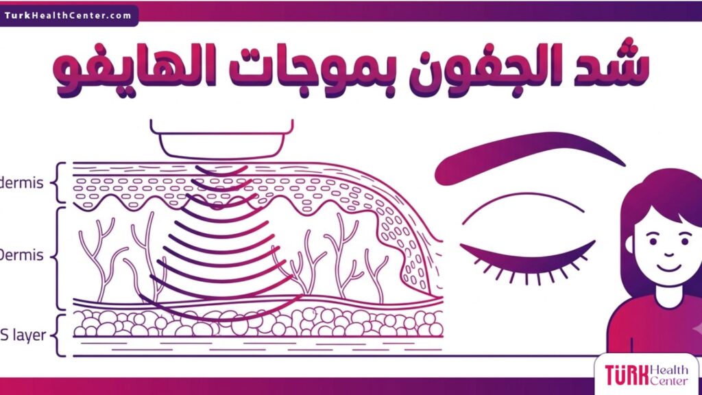إنفوجرافيك تشريحي طبي يشرح طبقات الجلد وكيفية عمل تقنية شد الجفون بموجات الهايفو داخلياً.