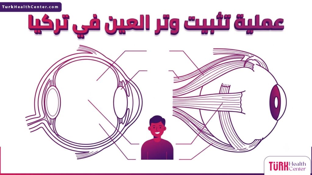 إنفوجرافيك طبي تشريحي يوضح هيكل عضلات العين والأساس العلمي لنجاح عملية تثبيت وتر العين في تركيا.