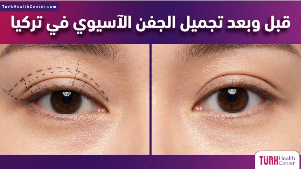 مقارنة قبل وبعد تجميل الجفن الآسيوي في تركيا تظهر تحديد الجفن المزدوج ونتائج العملية.