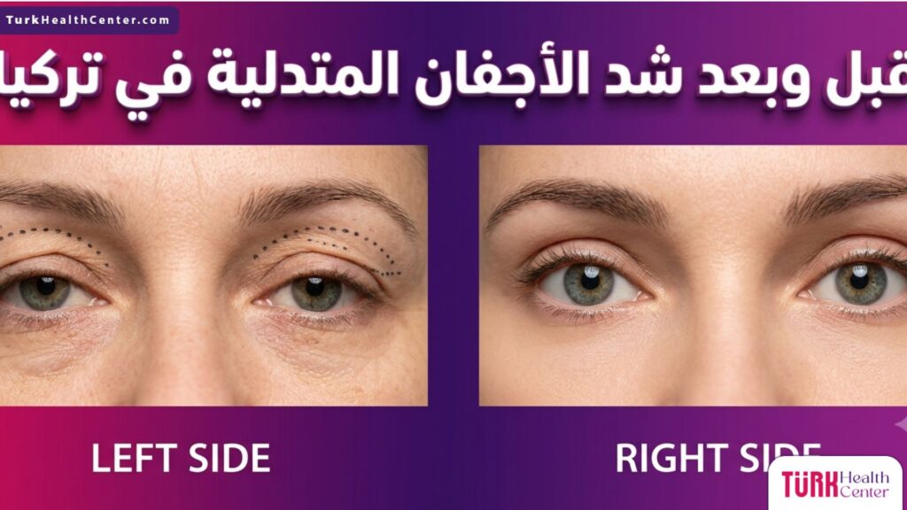 مقارنة لنتيجة قبل وبعد إجراء عملية شد الأجفان المتدلية في تركيا مع توضيح العلامات الجراحية.