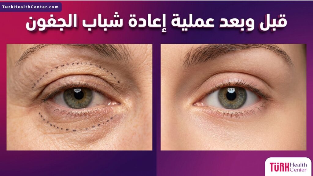 مقارنة قبل وبعد لنتائج عملية إعادة شباب الجفون مع توضيح شد الترهلات.