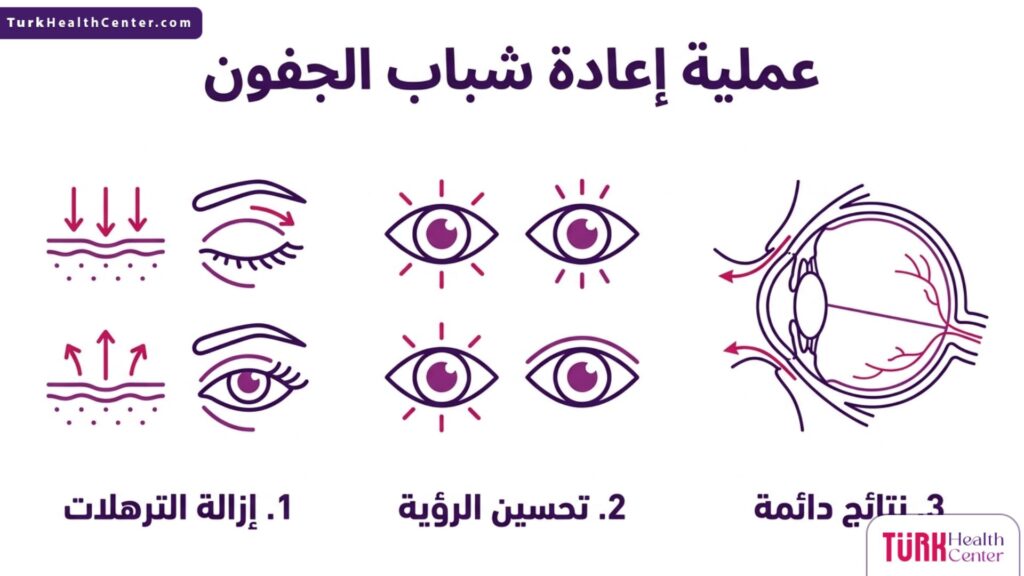 تصميم إنفوجرافيك يوضح فوائد عملية إعادة شباب الجفون بثلاث خطوات أساسية.
