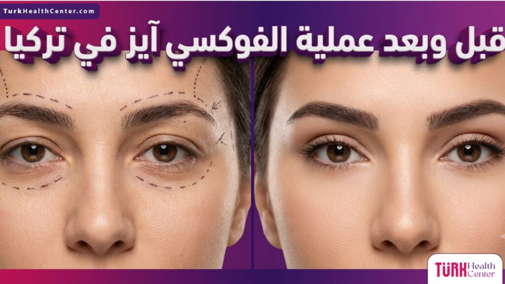 صورة مقسمة لنتائج قبل وبعد عملية الفوكسي آيز في تركيا تظهر تحديد زوايا العين ورفع الحواجب.