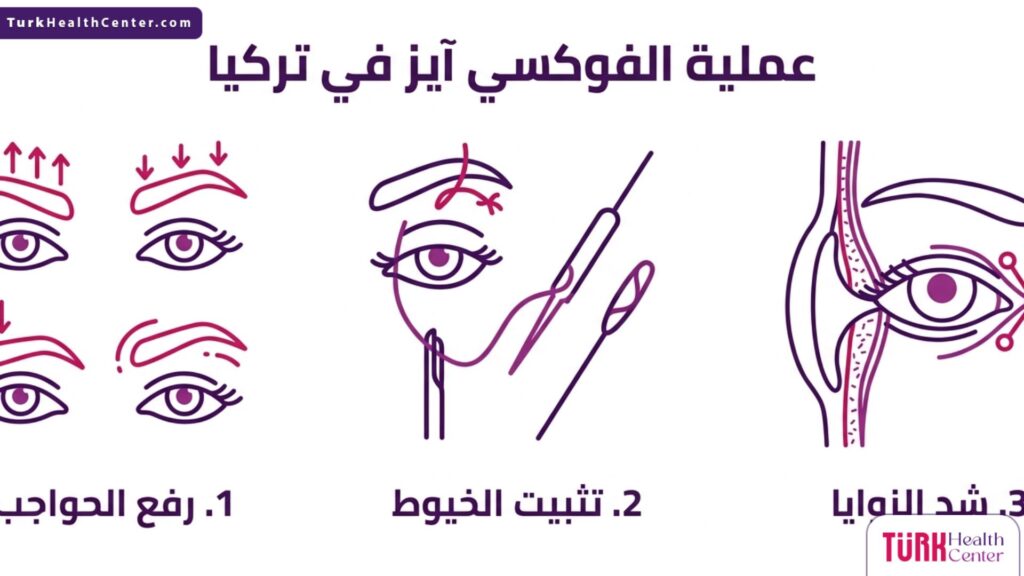 مخطط إنفوجرافيك ثلاثي الأقسام يوضح خطوات وتقنيات عملية الفوكسي آيز في تركيا.