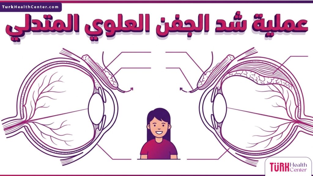 إنفوجرافيك طبي تشريحي يوضح التركيب الداخلي للعين والخطوات الدقيقة لنجاح عملية شد الجفن العلوي المتدلي.