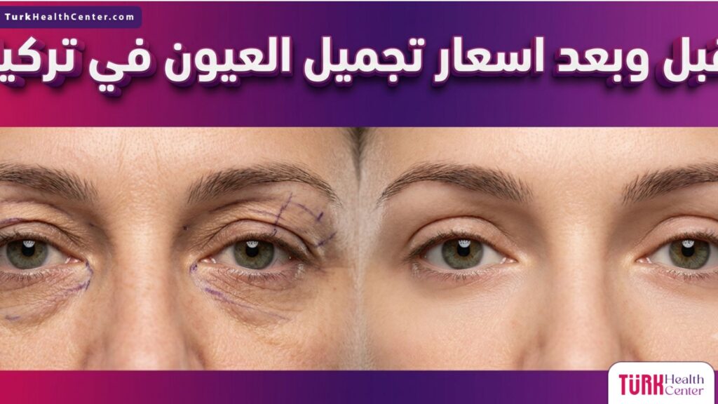 مقارنة قبل وبعد توضح نتائج العمليات والتحول قبل وبعد اسعار تجميل العيون في تركيا